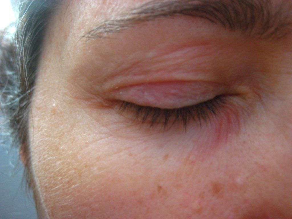 Patch Dry Red Skin Under Eye Losangeleswestern